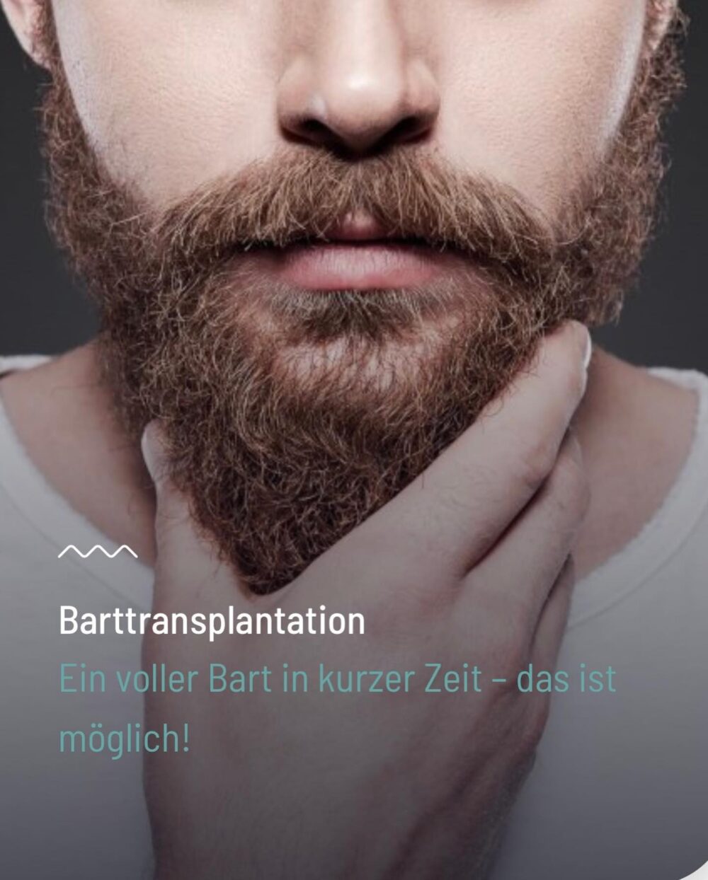 Barttransplantation
